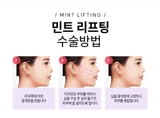 민트 리프팅 수술방법 - 1.귀 뒤쪽에 작은 절개창을 만듭니다. 2.디자인된 부위를 따라서 실을 주입 후 실의 돌기가 피부에 잘 걸리도록 합니다. 3.실을 절개창에 고정하고 피부를 봉합합니다.