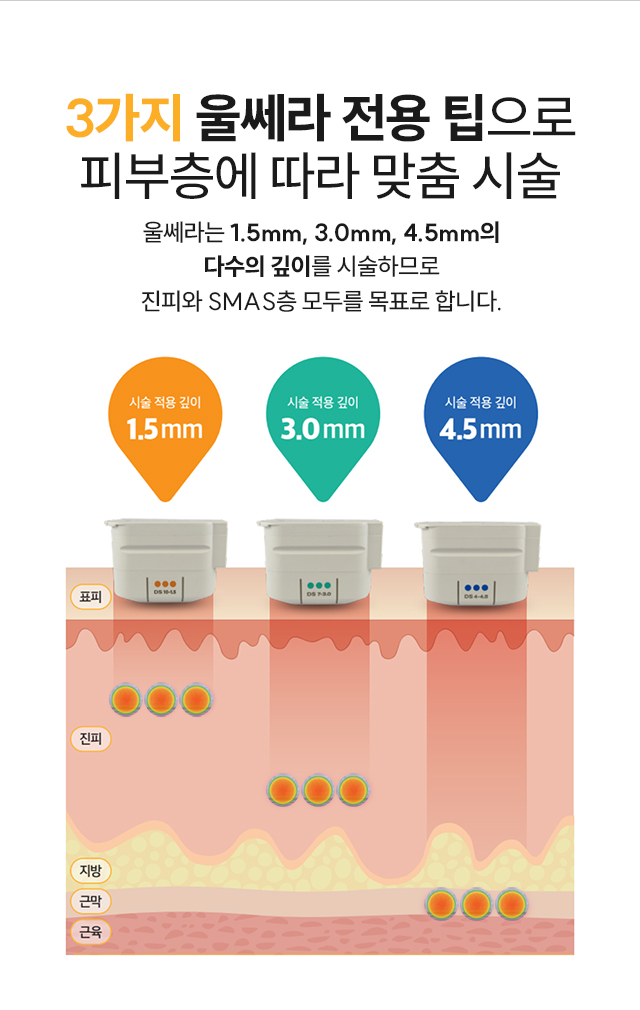 3가지 울쎄라 전용 팁 - 피부층에 따라 맞춤 시술