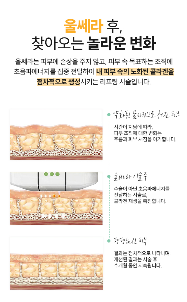 울쎄라 후, 찾아오는 놀라운 변화 - 내 피부 속의 노화된 콜라겐을 점차적으로 생성